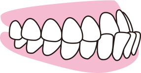 反対咬合（下顎前突）